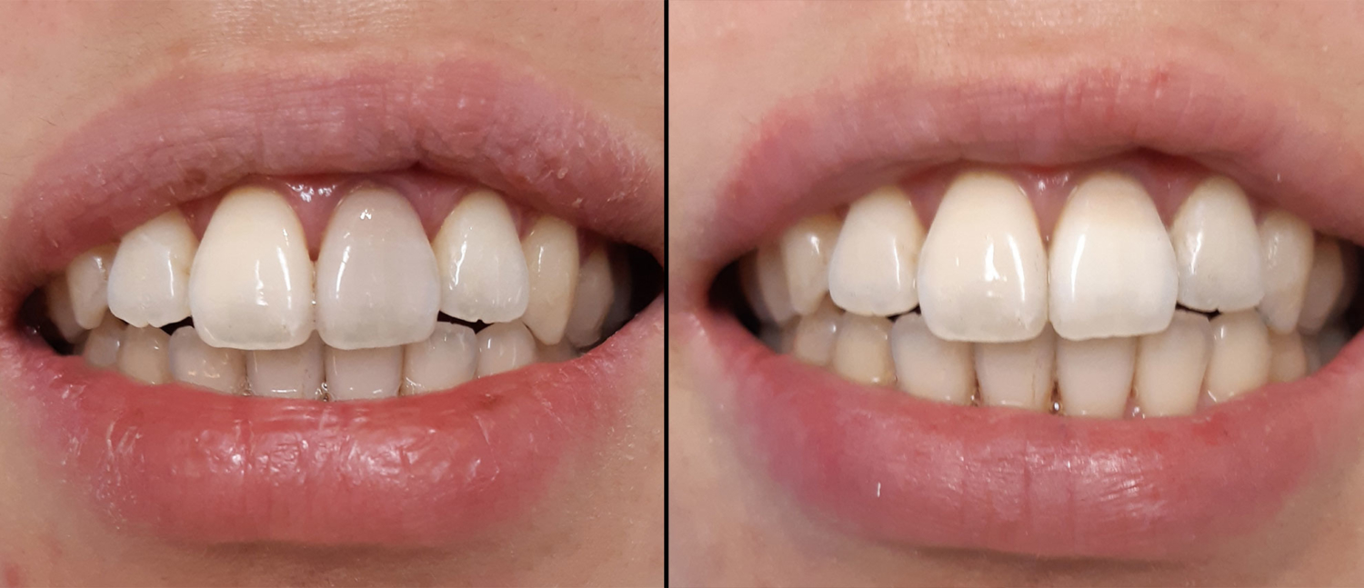 Eclaircissement dentaire à Paris Auteuil Dentiste Paris 16 Auteuil